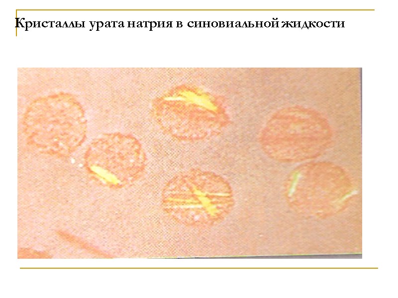 Кристаллы урата натрия в синовиальной жидкости